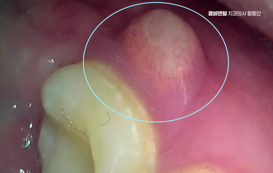 어금니 뒤 잇몸 부음 어떤 문제길래 이런거죠 관련 이미지 6