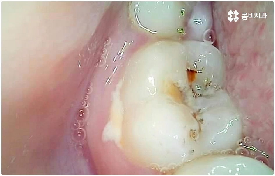 명동치과 평소에 케어하기 관련 이미지 5