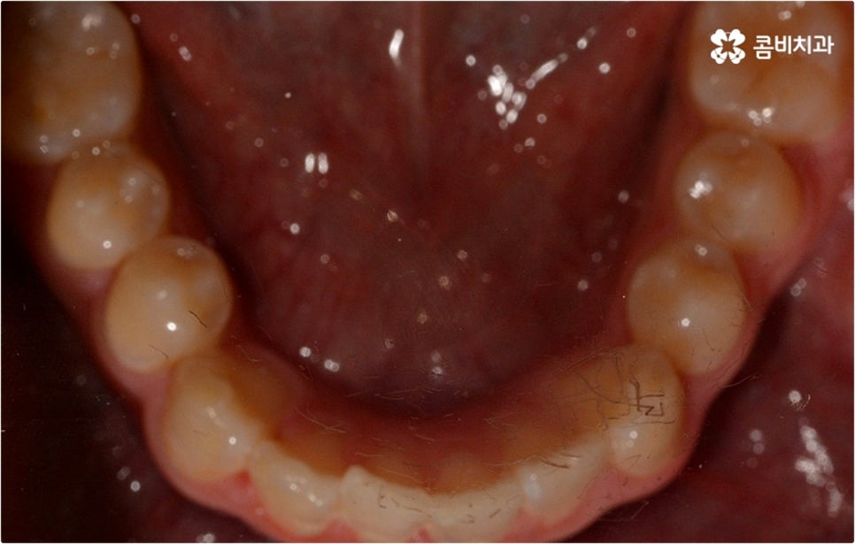 덧니교정 하고싶다면 관련 이미지 5