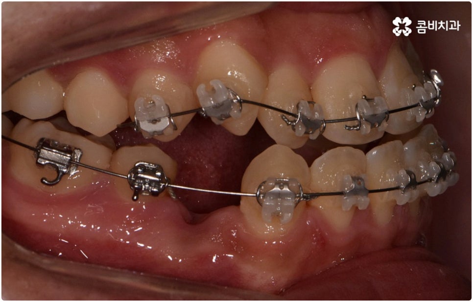 부정교합 3급 고치는 방법은 관련 이미지 7