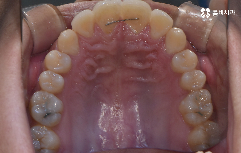 앞니만 교정 과잉치 뽑아서 해결했어요 관련 이미지 14