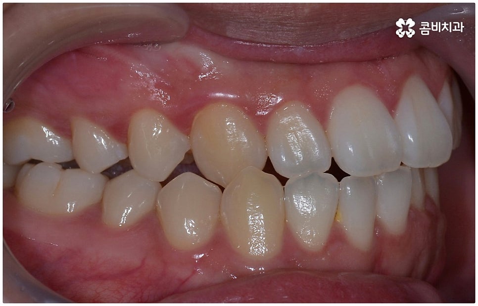 부정교합 3급 왜 고쳐야 하나요 관련 이미지 5