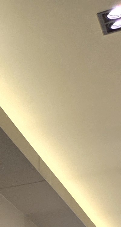 아말감 교체 레진 인레이 어떻게 대처하면 될까 관련 이미지 19