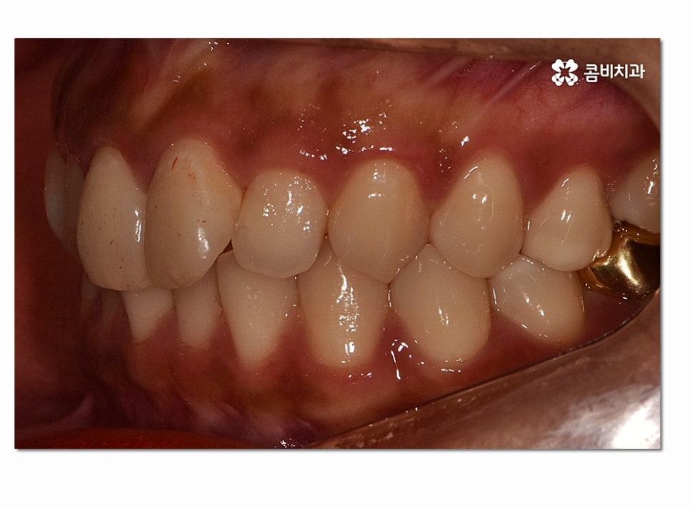 앞니 부분교정 오래 걸리지 않고 원하는 부위만 관련 이미지 4