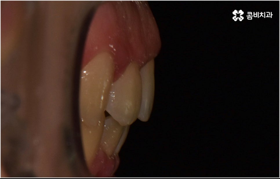 성인 치아교정 기간 걱정이 앞서나요 관련 이미지 14