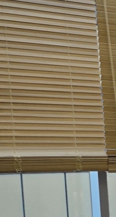 임플란트 뼈이식 안하면 어떤 문제가 있는거죠 관련 이미지 23