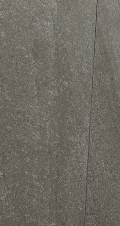 앞니 신경치료 크라운 까지 해야할 상황이라면 관련 이미지 45