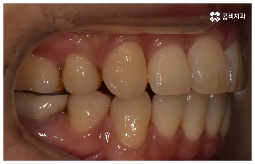 중년치아교정 원한다면 관련 이미지 17