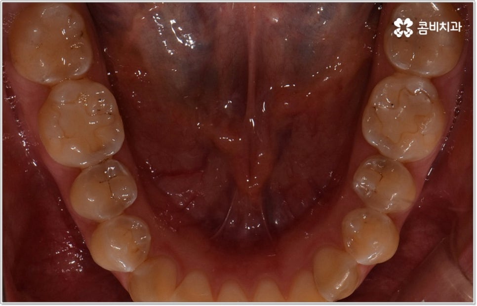비발치치아교정 언제 할수있나요 관련 이미지 6