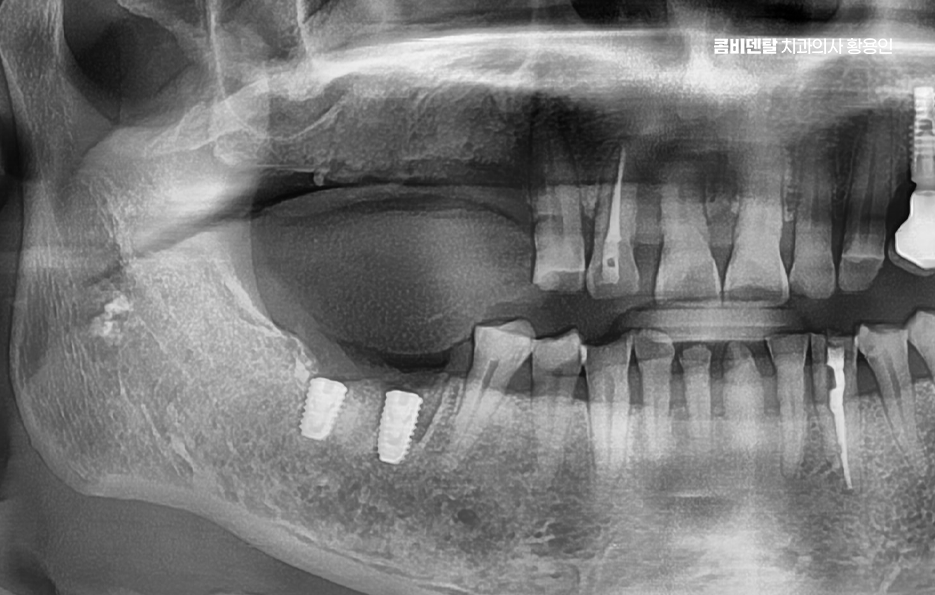 어금니 임플란트 과정 제대로 이해하려면 관련 이미지 4