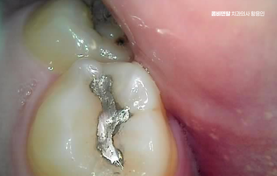 아말감 교체 시기 이렇게 따져보세요 관련 이미지 8