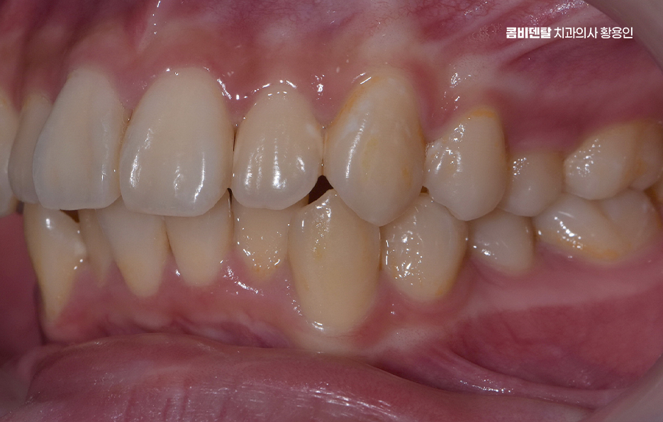 부정교합 교정 안하면 생기는 문제는 뭔가요 관련 이미지 3