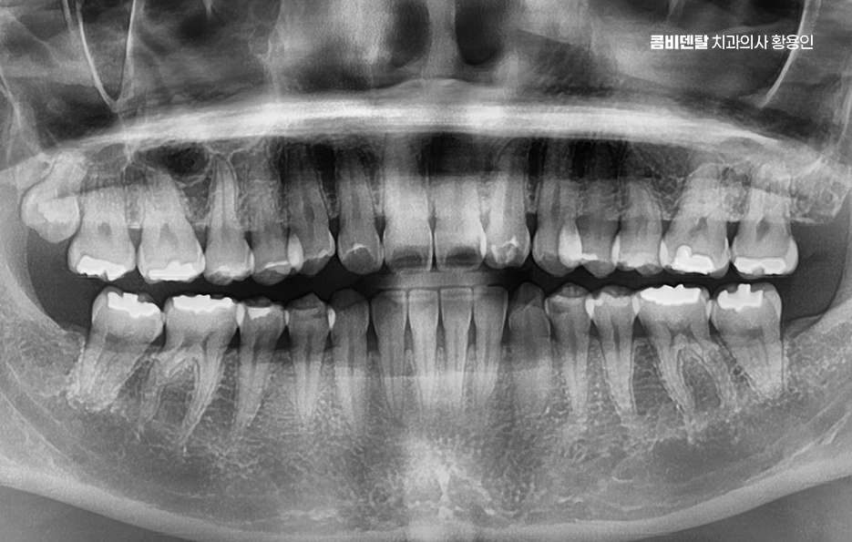 인레이 치료 후 통증 자꾸 심해지는데 괜찮은걸까 관련 이미지 1