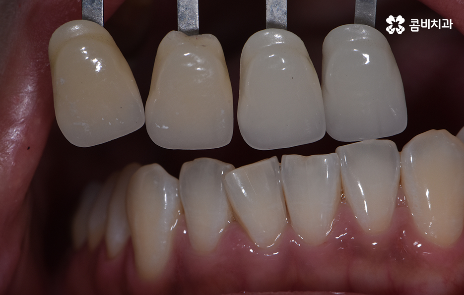 치아 깨짐 다시 튼튼하게 수복하기 위한 방법 관련 이미지 10