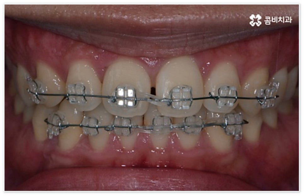 앞니 벌어짐 고치고 싶어요 관련 이미지 5