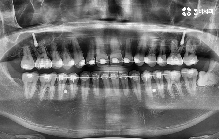 사랑니 발치 시기 이럴때 시작하면 좋아요 관련 이미지 3