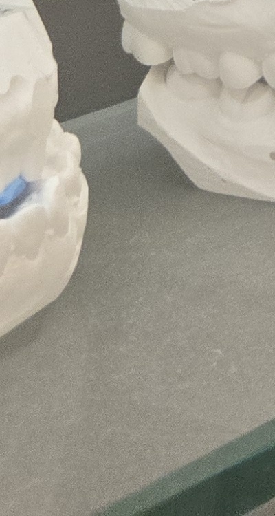 앞니 틀어짐 부분교정 얼마나 걸릴까 관련 이미지 44