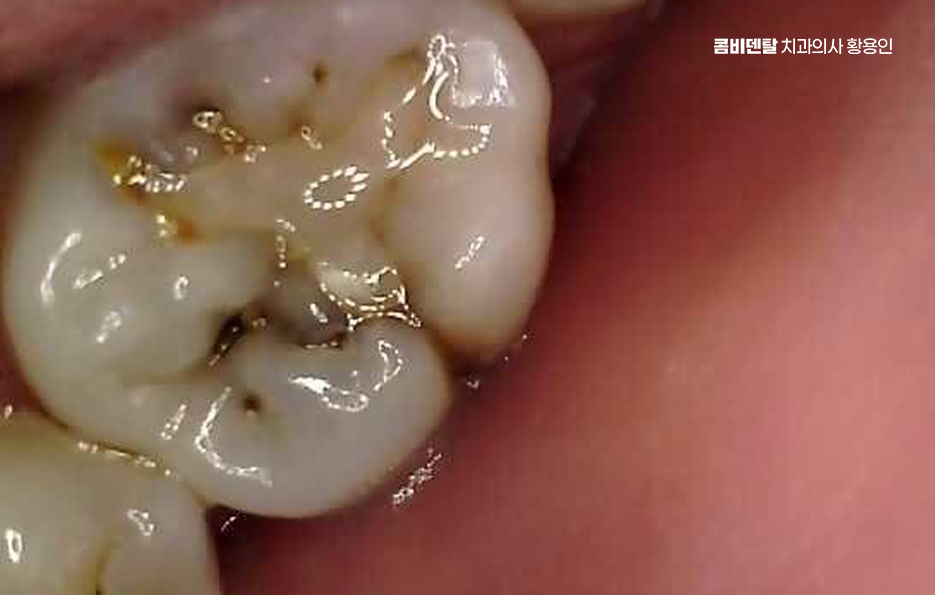 신경치료 아픈가요 망설이시는 분들이라면 관련 이미지 7
