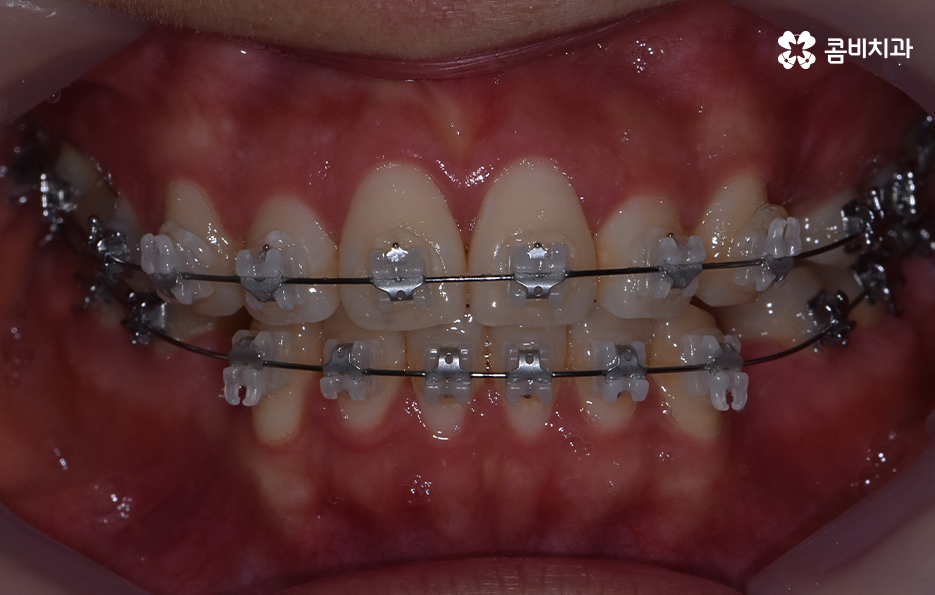돌출입발치교정 기대해봐도 될까요 관련 이미지 6