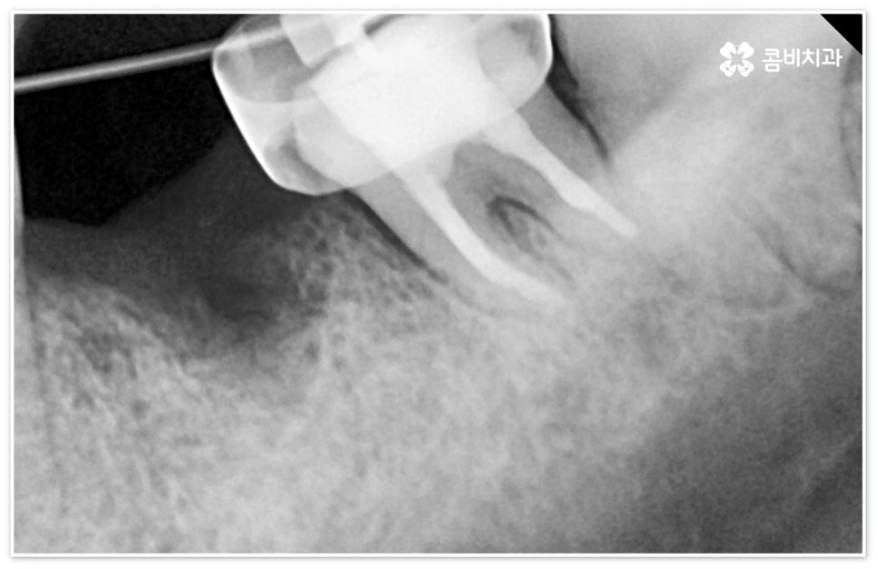 신경치료통증 무섭다고 미루면 관련 이미지 9