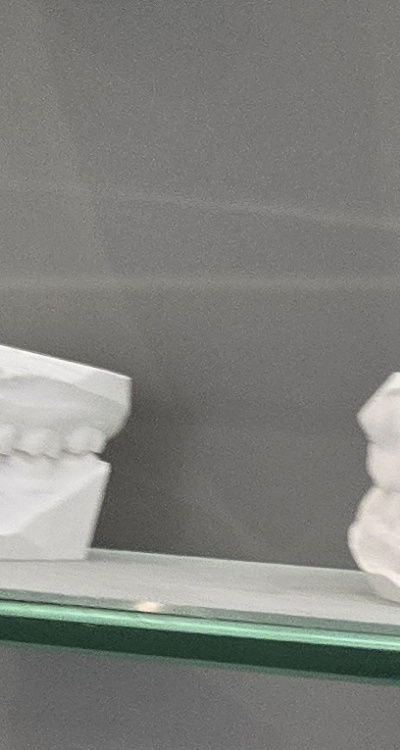 윗니 전체 임플란트 뭐부터 해야할까 관련 이미지 24