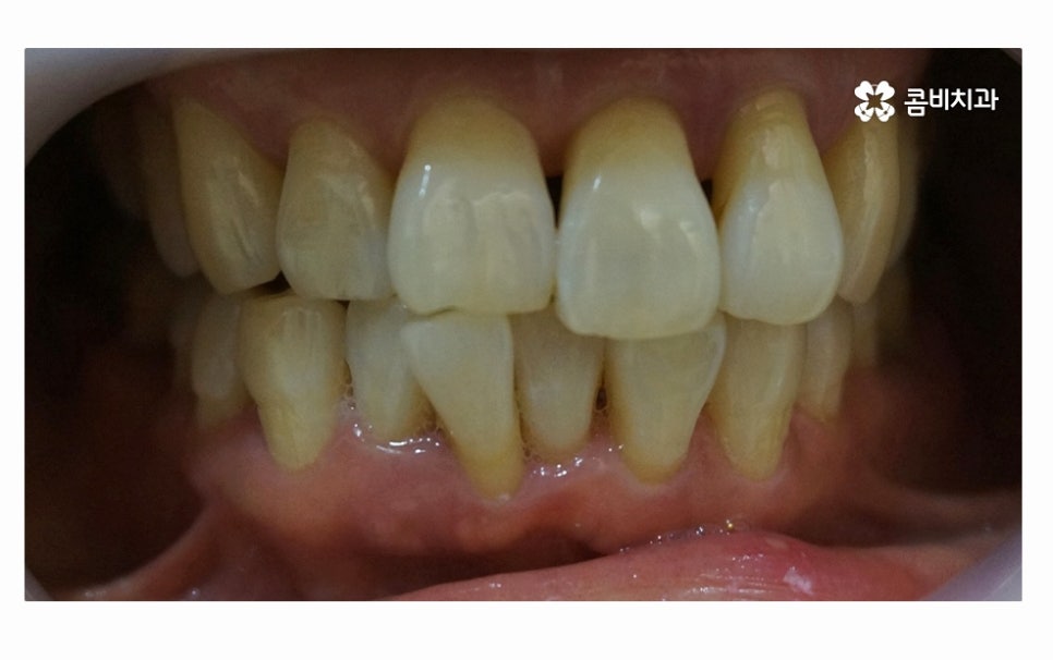 어금니 발치 심각해지기 전에 막으려면 관련 이미지 2