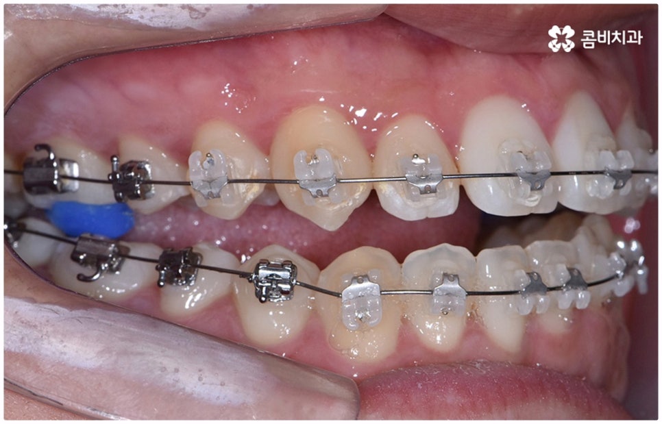부정교합 3급 왜 고쳐야 하나요 관련 이미지 8