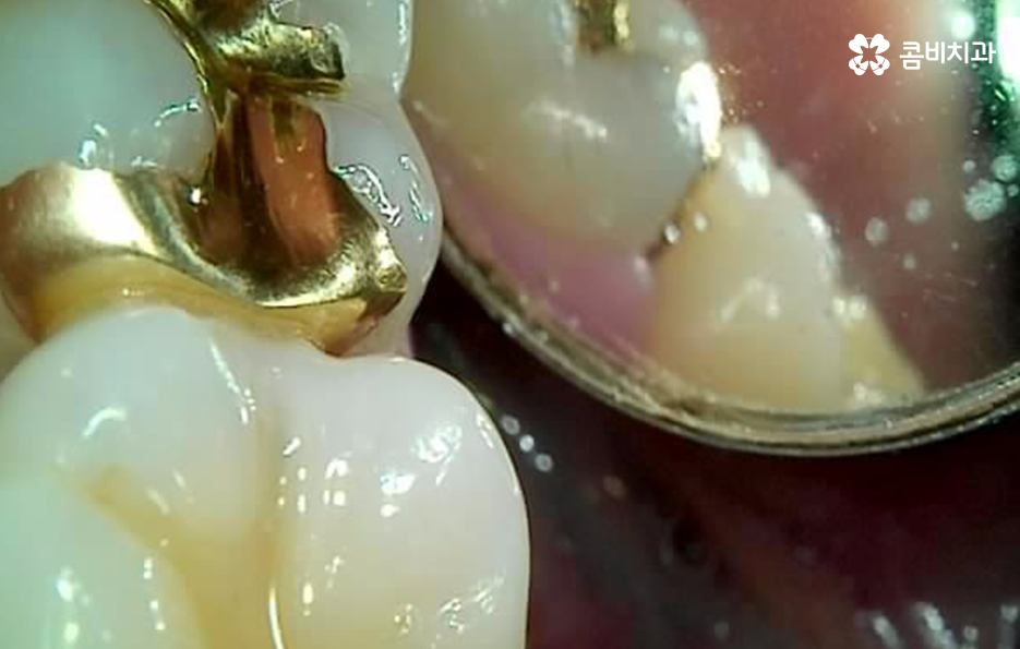 치아 사이 충치 까다로운 이유부터 알아보시죠 관련 이미지 9