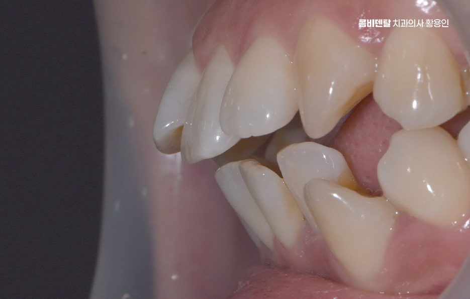 앞니 틀어짐 교정 조화롭게 마무리하려면 관련 이미지 4