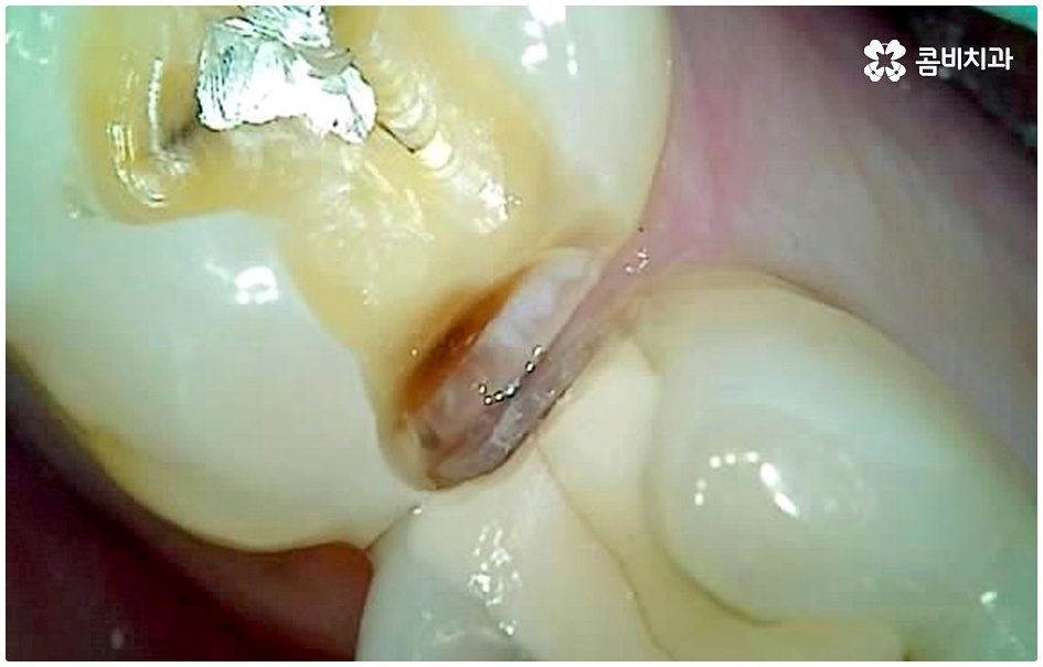 명동치과 평소에 케어하기 관련 이미지 8
