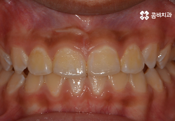 성장기치아교정 어떻게 접근하는 것이 좋을까 관련 이미지 6