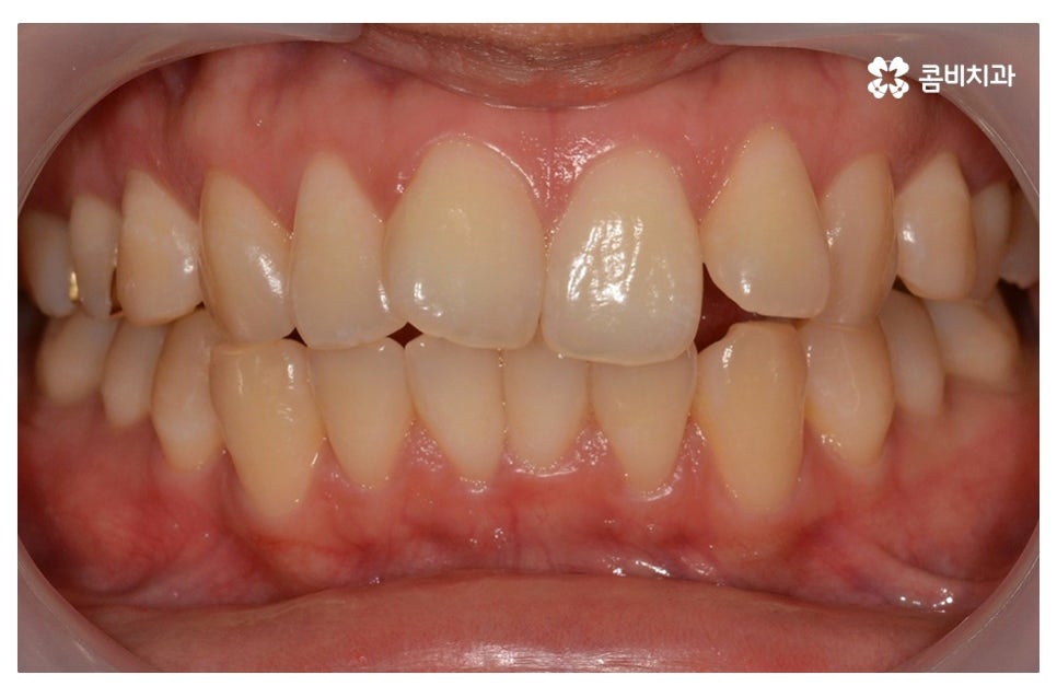 덧니교정 정확하게 알아보려면 관련 이미지 1