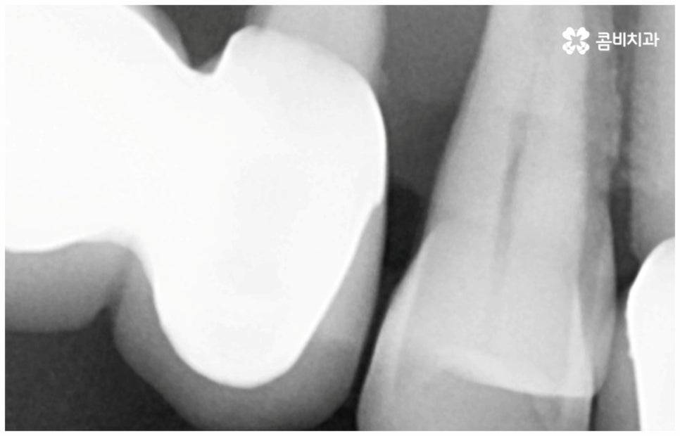 임플란트수명 연장하려면? 관련 이미지 3