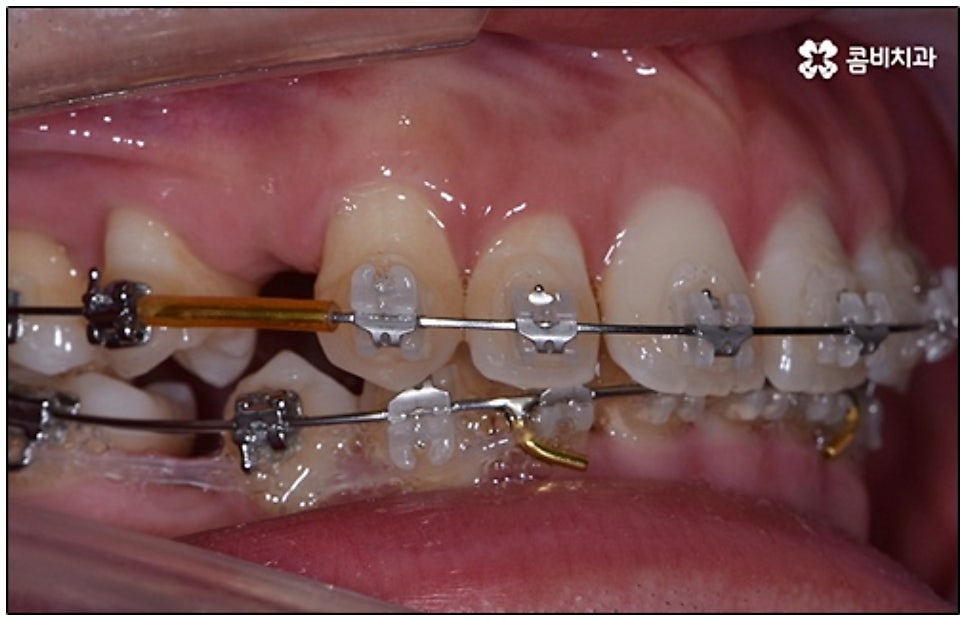 클리피씨교정 알아봐야 할것들 관련 이미지 7