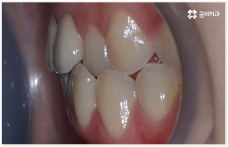 치아교정장치 어떻게 고르나요 관련 이미지 15