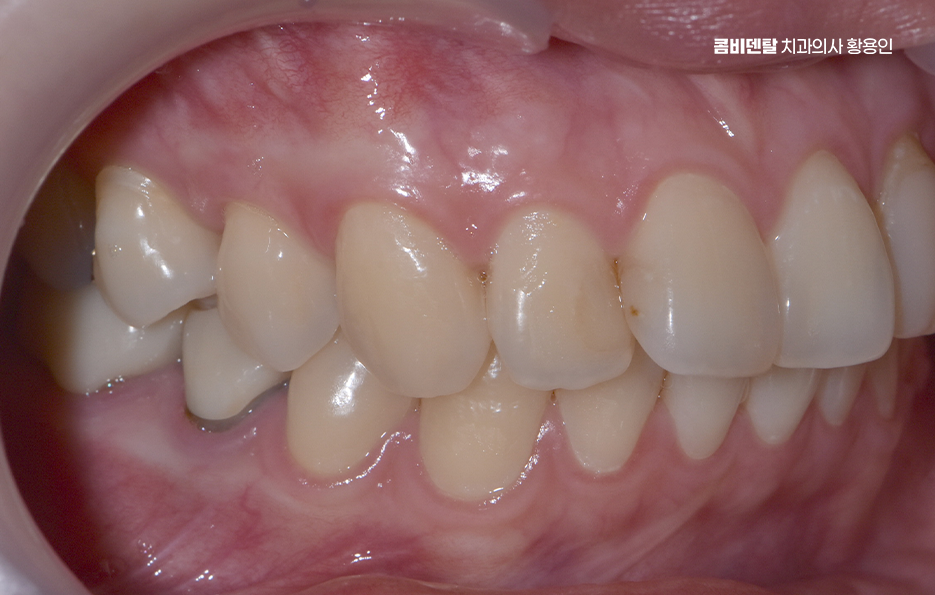 앞니 틀어짐 부분교정 얼마나 걸릴까 관련 이미지 3