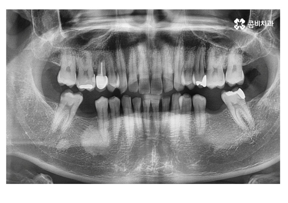 20대임플란트 잦아지는 이유를 알아본다면 관련 이미지 6