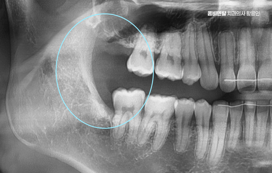완전매복사랑니 발치 대학병원 꼭 가야하나요 관련 이미지 6