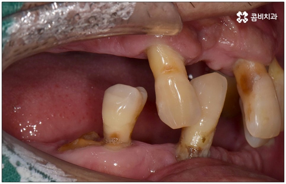 노인임플란트 참고사항 알아봐요 관련 이미지 4