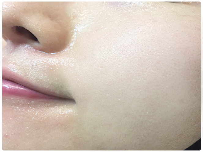 피지제거기 자극없이 뽑아 관련 이미지 6