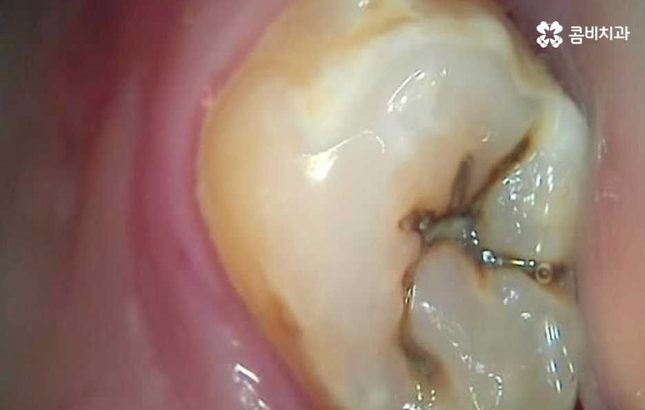 충치 단계 어떻게 분류하고 치료해야 하나요 관련 이미지 10