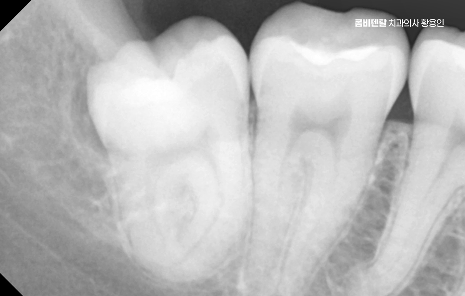 명동치과 흔하게 놓치는 사례를 정리해요 관련 이미지 9
