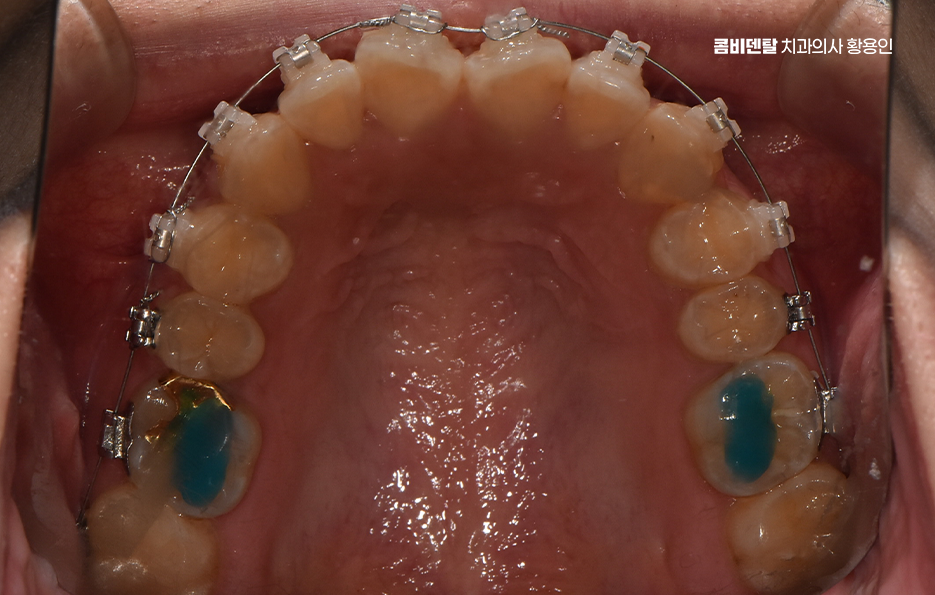 How Can You Determine the Duration of Front Teeth Orthodontic Treatment? image 10