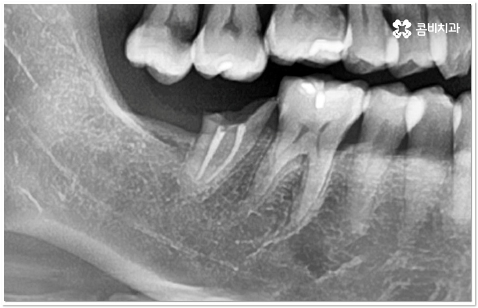 어금니 충치치료 빠를수록 좋아요 관련 이미지 4