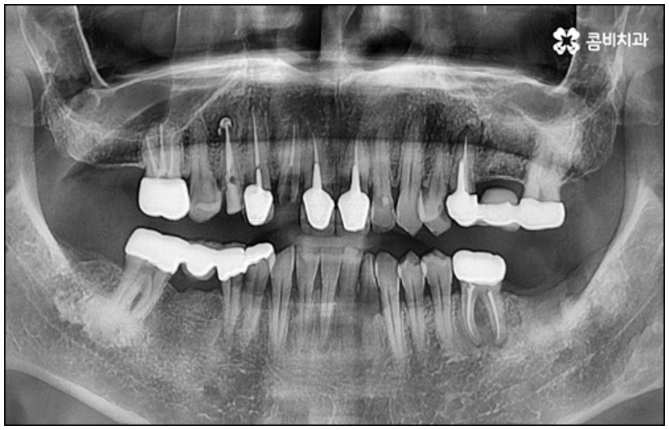 당일임플란트 나도 할수있나요 관련 이미지 1