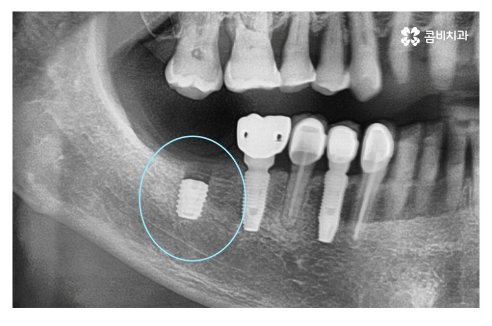 임플란트 기간 케이스에 따라 달라진다면 관련 이미지 3