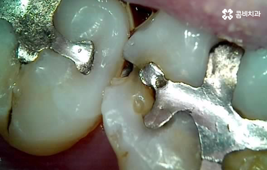 어금니 충치 발치 결국 뽑아야 할때와 살릴 수 있는 케이스 관련 이미지 6
