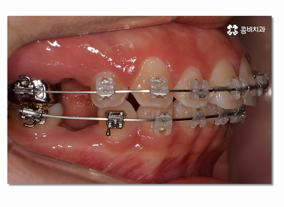 돌출입치아교정 부담이 크게 느껴진다면 관련 이미지 5