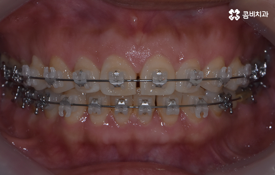 중년치아교정 이제라도 해도 될까요 관련 이미지 11