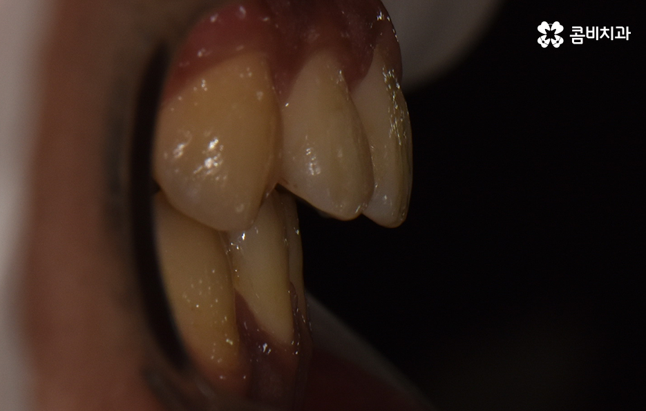 성인 부정교합 교정 더는 미루고 싶지 않다면 관련 이미지 9